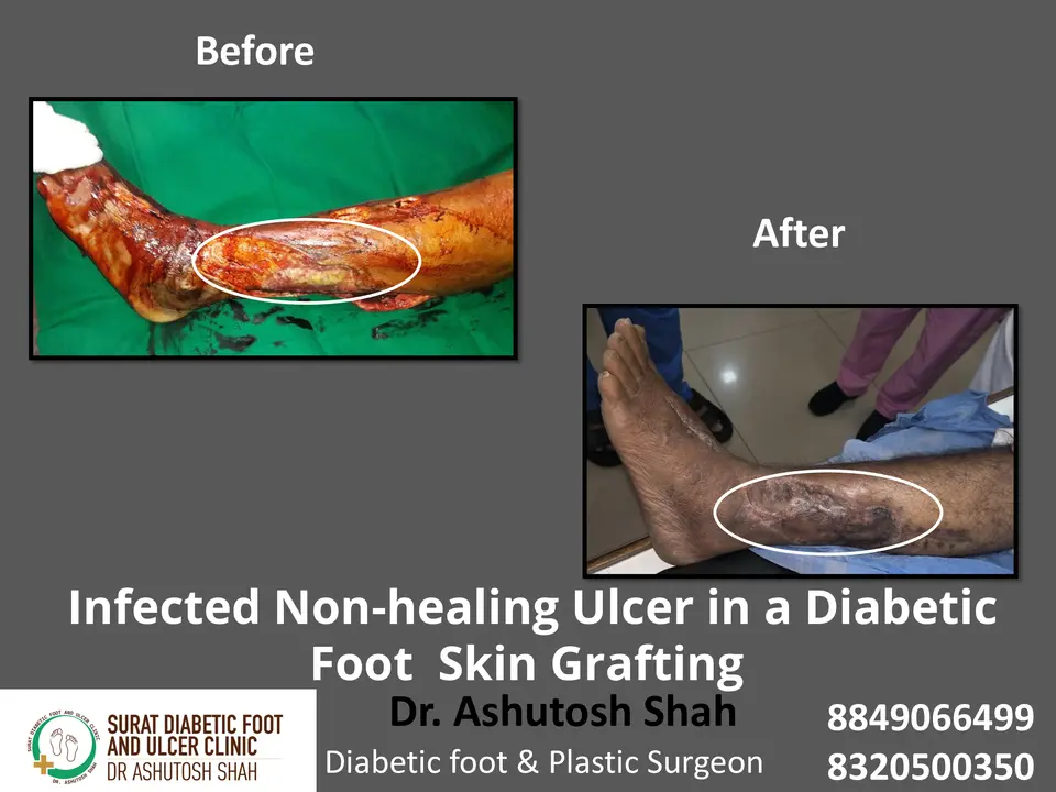 Debridement and Skin Grafting.pptx-7.webp